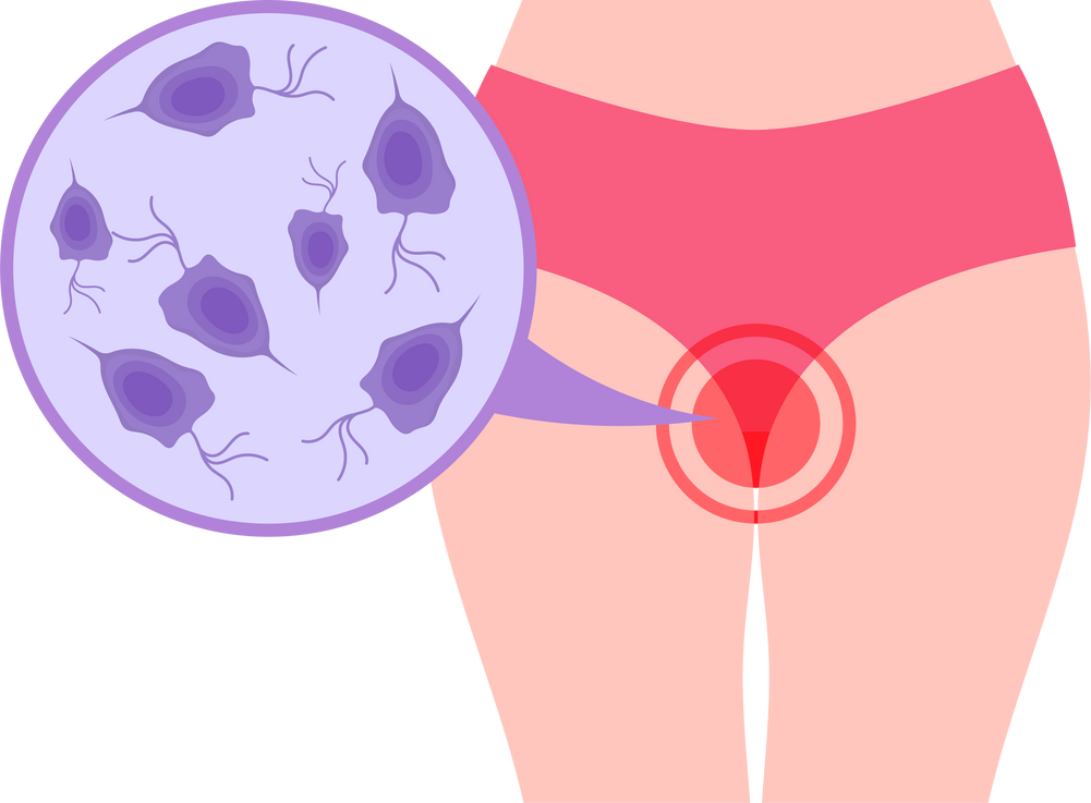 trichomonas vaginal trichomoniasis discharge Bacterial vaginosis HPV virus candidiasis Transmitted Disease Chlamydia Gonorrhea vagina cancer odor bacteria pain cervix yeast Itching warts